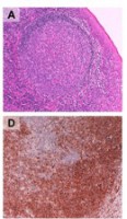 Malignant Lymphomas